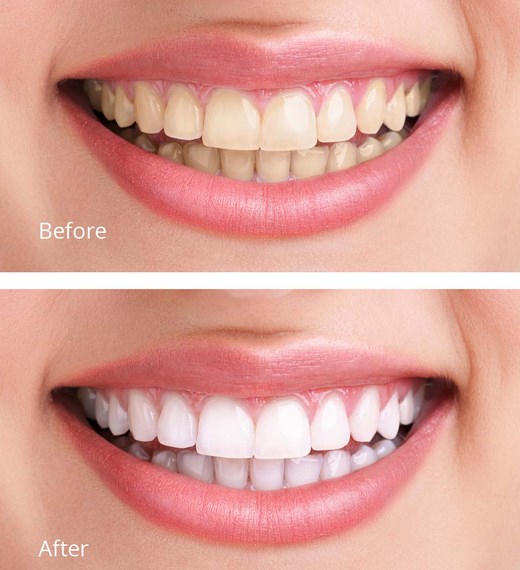 teeth-whitening-before-and-after